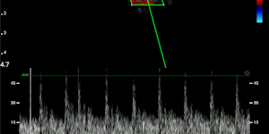 Carotid