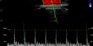 Carotid