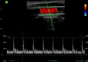 Carotid