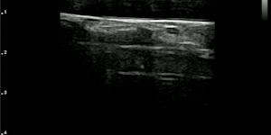 Carotid
