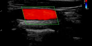 Carotid