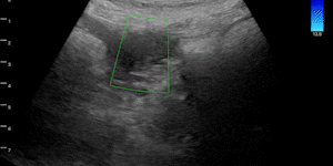 Colon tumor