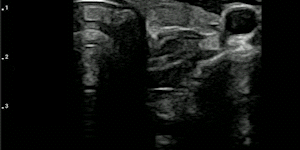 Esophagus
