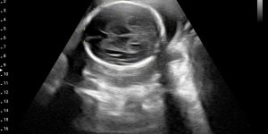 Fetus, 24wk