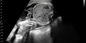 Fetus, 26wk