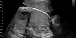 Fetus, 37wk