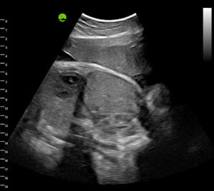 Fetus, 37wk