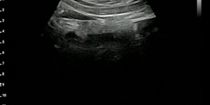 Inferior vena cava