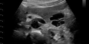 Intraductal papillary mucinous neoplasm