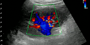 Kidney