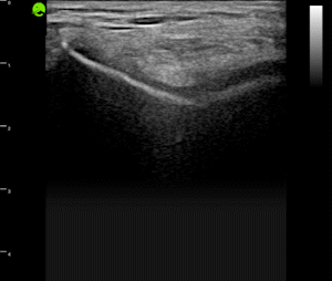 Knee (femoral articular cartilage)