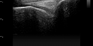 Knee (infrapatellar tendon)