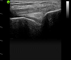 Knee (infrapatellar tendon)