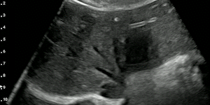 Liver