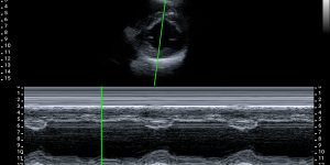 Parasternal short-axis view