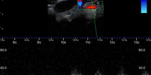 Post-vaccination axillary lymph node hyperplasia