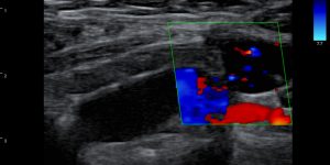 Post-vaccination axillary lymph node hyperplasia