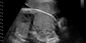 Pregnant, 37wk