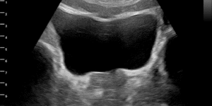 Prostate gland