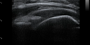 Shoulder (supraspinatus tendon tear, fluid collection, visible humeral cartilage)