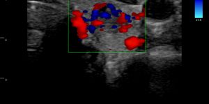 Thyroid gland