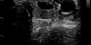 Thyroid gland cyst