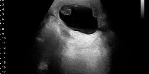 Urinary bladder mass