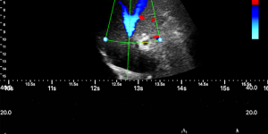 Hepatic vein