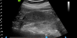 Kidney