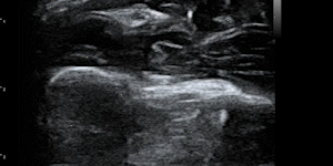 Median nerve