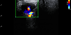 Parotid gland tumor