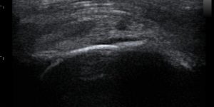 Rotator cuff