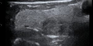 Thyroid gland nodule