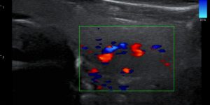 Thyroid gland nodule