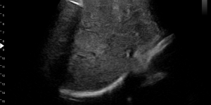 Uneven liver fatty infiltration