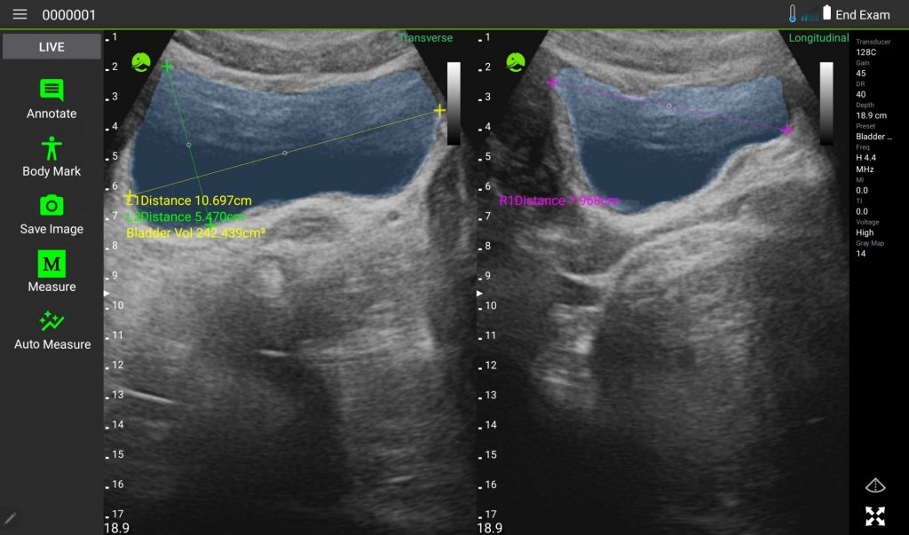 AutoMeasureBladder