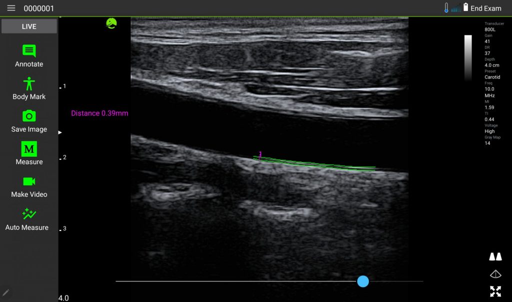AutoMeasureIMT